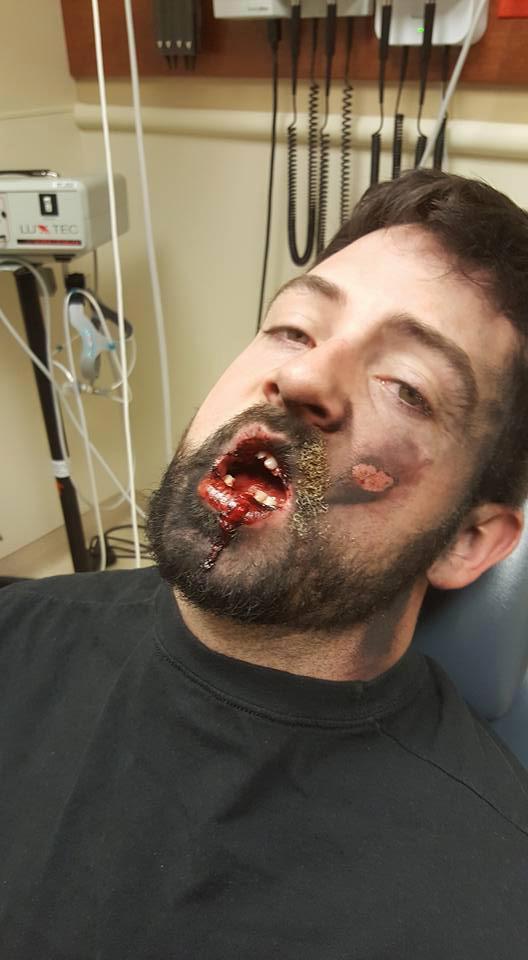 Vaper shares shocking pictures after suffering second-degree burns and losing seven teeth when e-cigarette exploded 