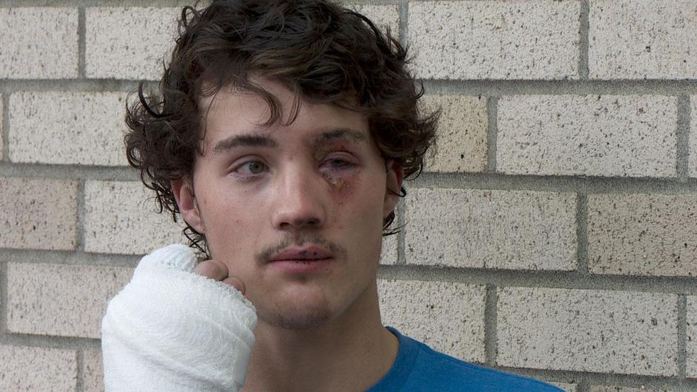 Oregon teen nearly loses eye as e-cigarette explodes in his face